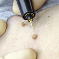 Phlebolyse Phlebolyse